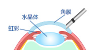 角膜を切開