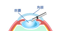 前嚢を切開