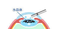 水晶体を吸引