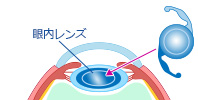 眼内レンズの挿入